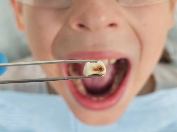 Best Urgent Care for Lost Fillings or Crowns in Chickasaw, AL