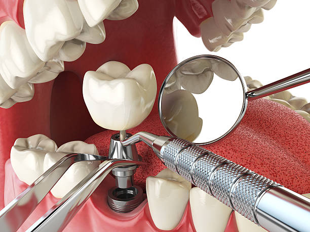 Best Emergency Treatment for Dental Infections or Abscesses in Chickasaw, AL